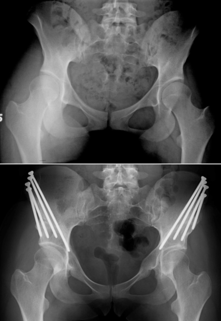 Bilateral acetabular hip dysplasia pre-op and post-op PAO surgery