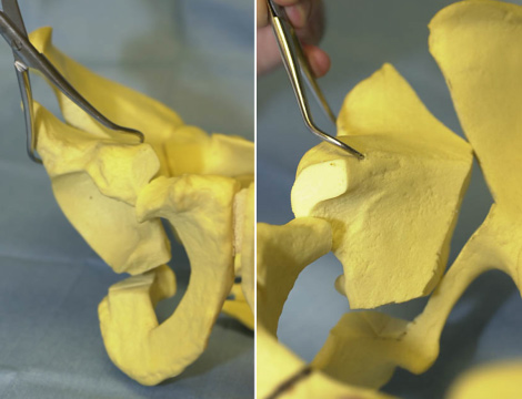 A model showing PAO surgery for acetabular dysplasia