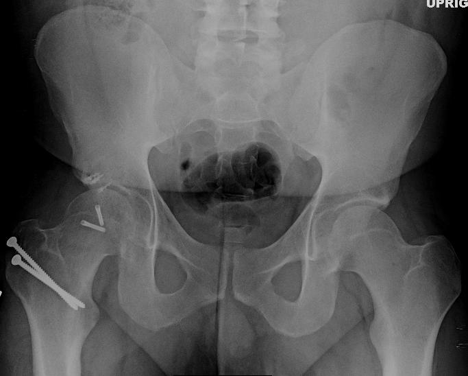 Post op Surgical dislocation for FAI after femoral head fracture malunion in an active young male