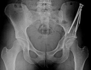 PAO surgery in collegiate swimmer after 2 previous failed hip ...